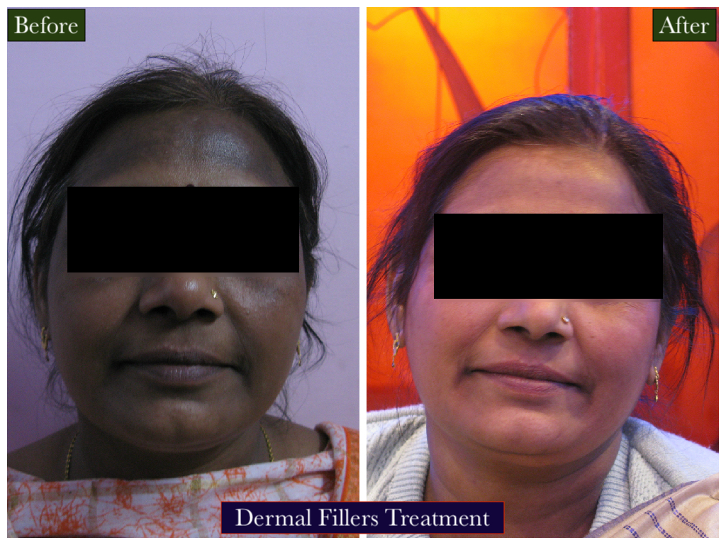 Thermal Filler Treatment